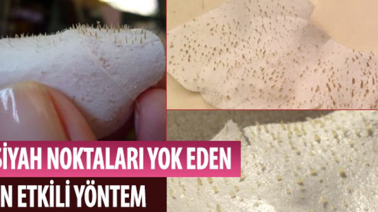 Yumurta Akı Maskesi: Siyah Noktalar İçin En Etkili Yöntem