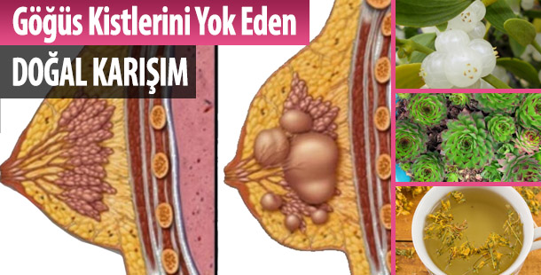 Göğüs Kistlerini Yok Eden Doğal Karışım