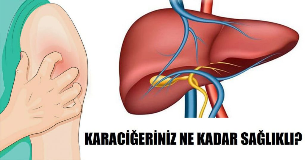 Sağlıksız Bir Karaciğere Sahip Olduğunuzun 5 Belirtisi