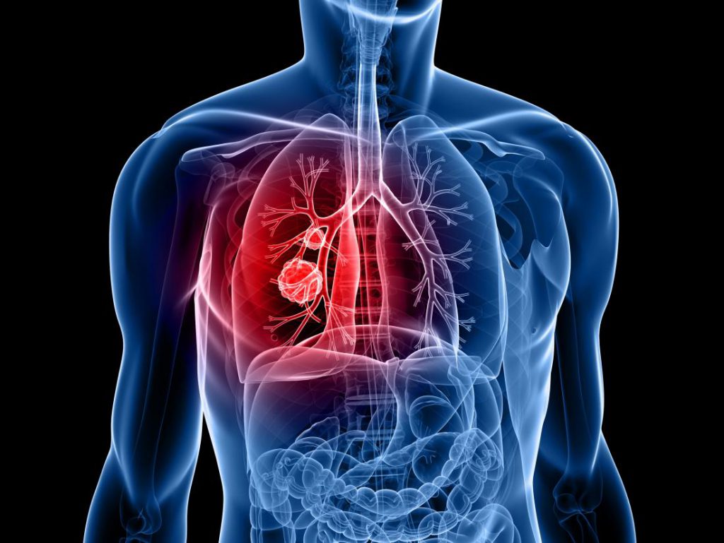 Akciğer Kanserinin Belirtileri ve Tedavisi