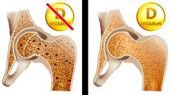 Vücudunuzun D Vitaminine İhtiyaç Duyduğunu Gösteren 8 Belirti