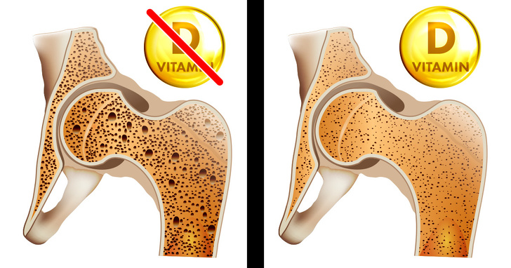 Vücudunuzun D Vitaminine İhtiyaç Duyduğunu Gösteren 8 Belirti