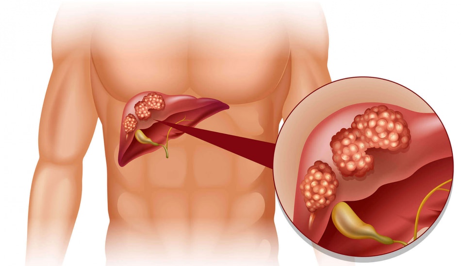 Karaciğer Kanserinin Belirtileri Nelerdir, Nasıl Anlaşılır?