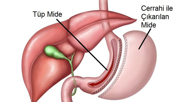 Tüp Mide Ameliyatı Riskli Midir?