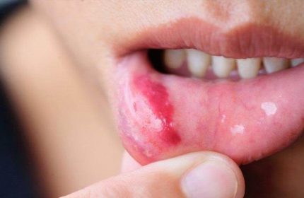 Pemfigus Nedir, Belirtileri Nelerdir?
