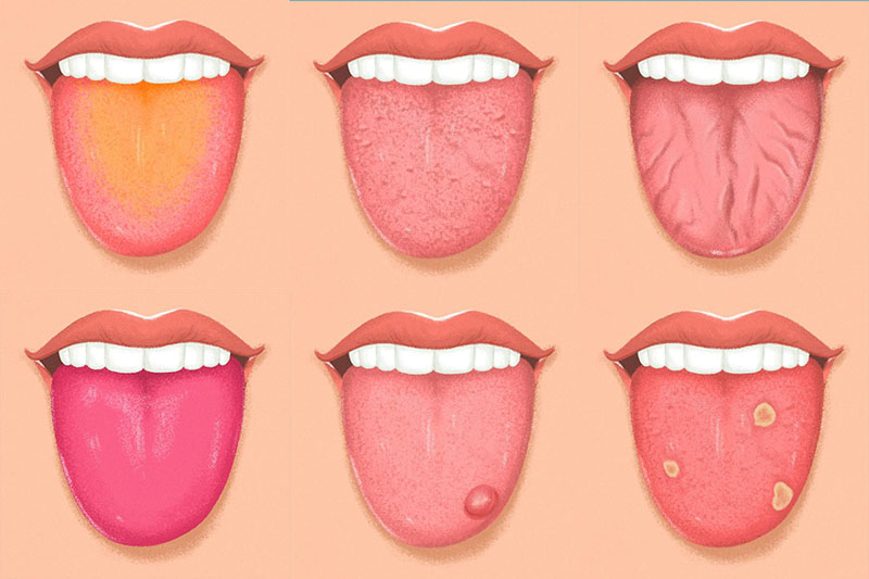 Dilinizdeki Bu Değişiklikler Sağlığınız Hakkında Uyarı Veriyor