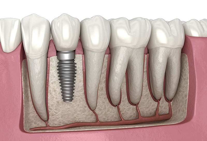 Dental Implant Tedavisi Hakkında Bilgi