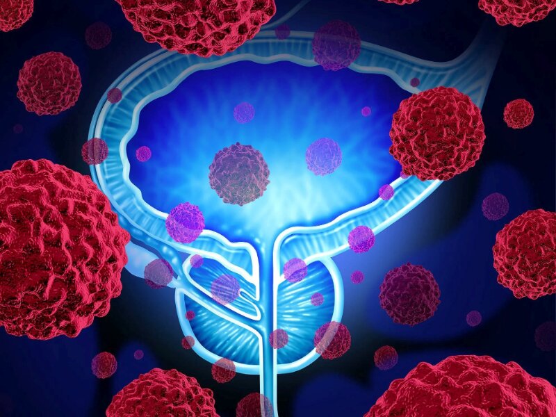 Kötü Huylu Prostat Kanseri Tedavisinde Yeni Yöntemler ve Cerrahi Seçenekler